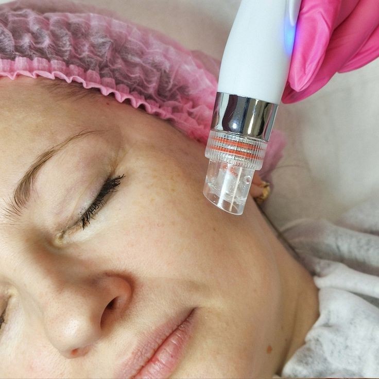 гидропилинг (вакуумная аппаратная чистка)