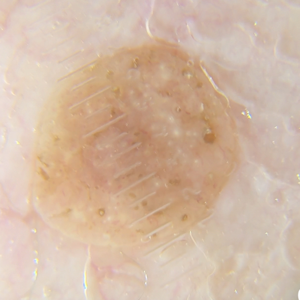 ДЕРМАТОСКОПИЧЕСКИЙ ОСМОТР (НОВООБРАЗОВАНИЙ НА ВСЕМ ТЕЛЕ)