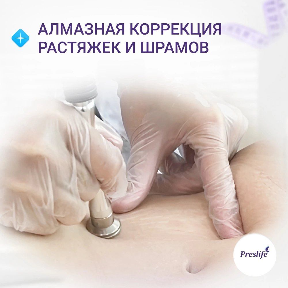 Алмазная коррекция шрамов и растяжек