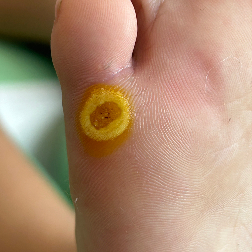 Бородавка 1 шт 1000₽  От 5 шт- 3000₽