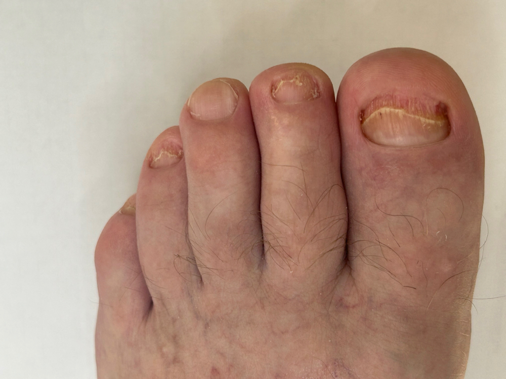 Зачистка грибковых ногтей  60% поражения