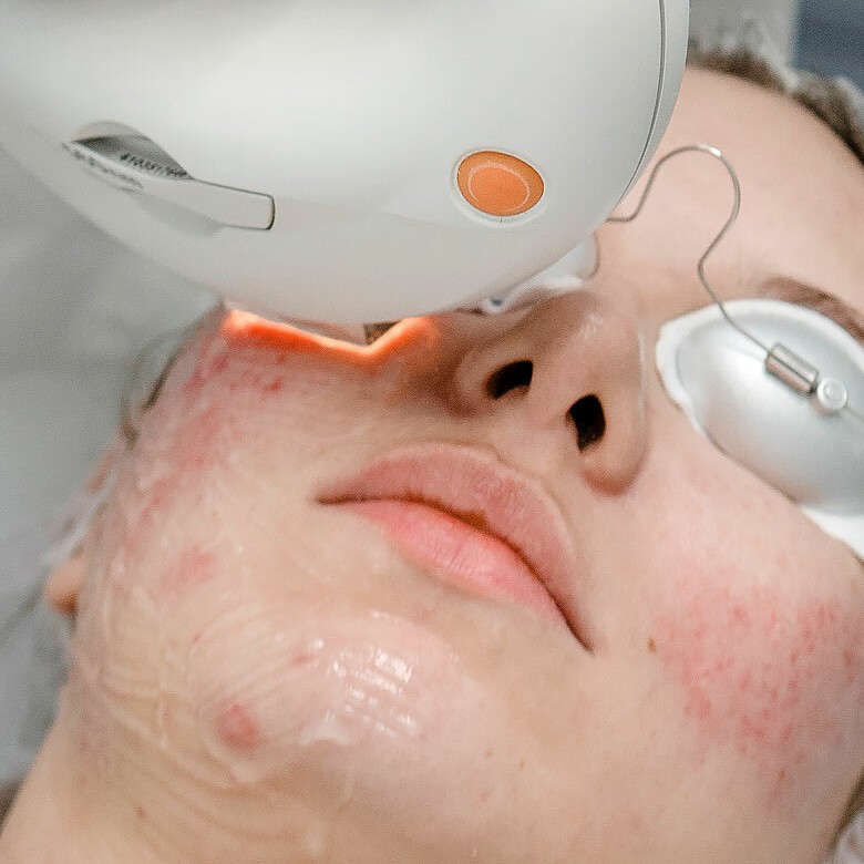 Фотоомоложение лицо +Лечение акне