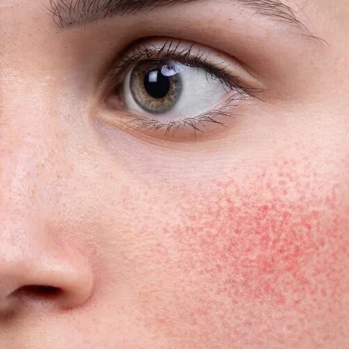 Уход за чувствительной и реактивной кожи с пептидами(омоложение)