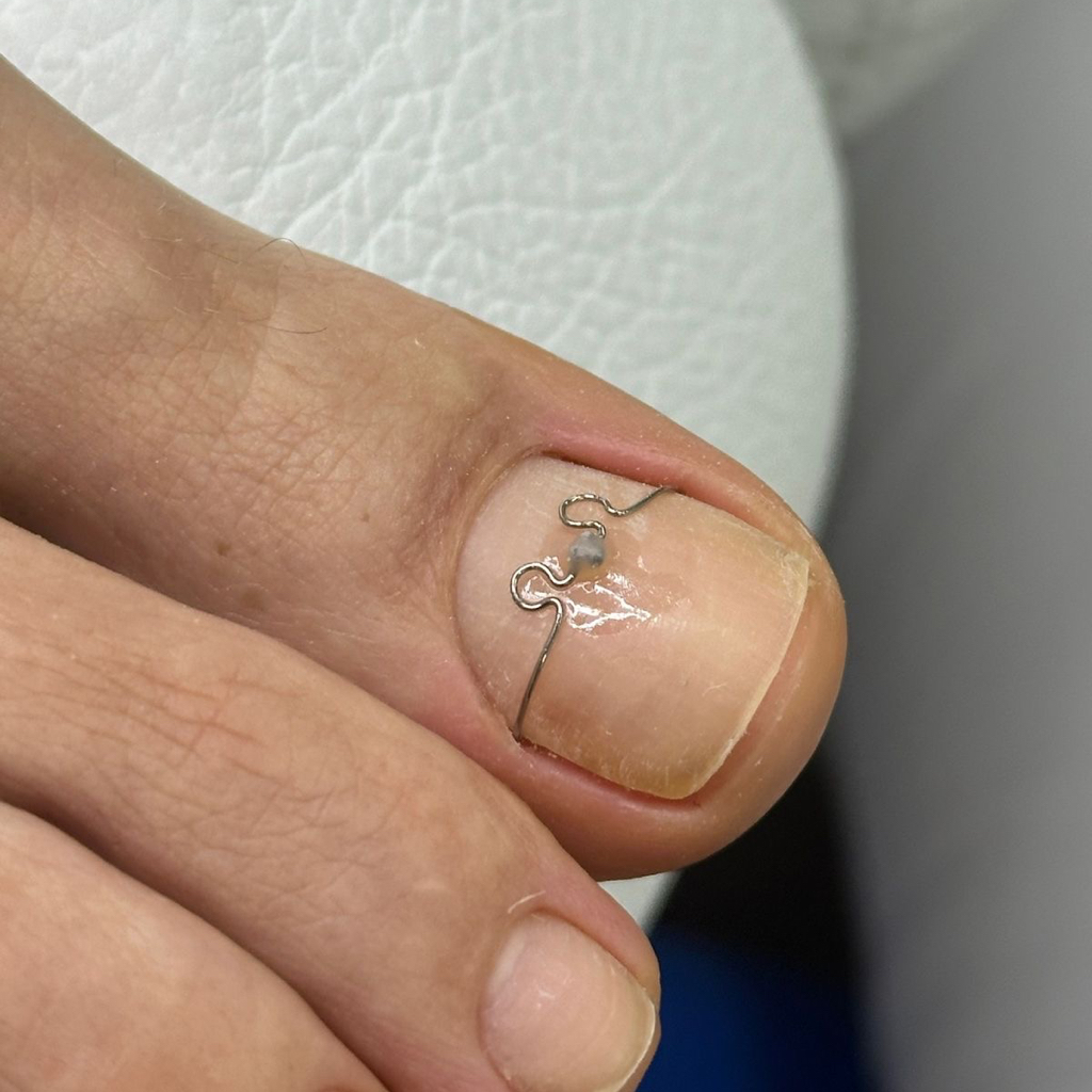 Установка корректирующей системы  «титановая нить» на ногтевую пластину 1ед