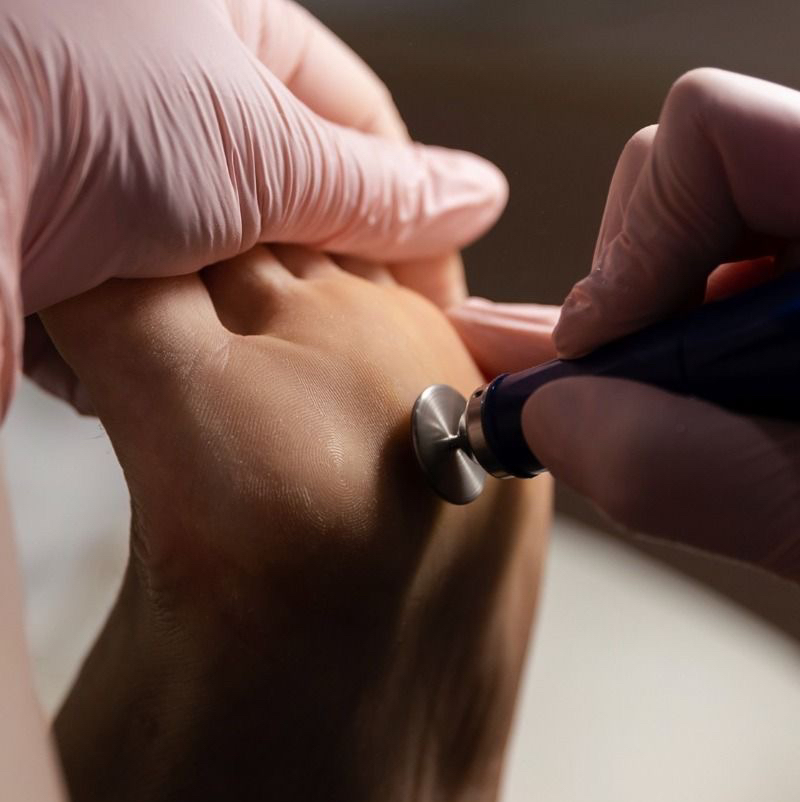 Обработка стержневой мозоли на стопах мелкие до 3 ед