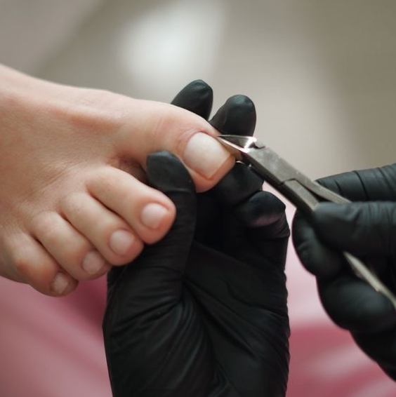 Обработка  ногтя при врастании с удалением сегмента ногтя