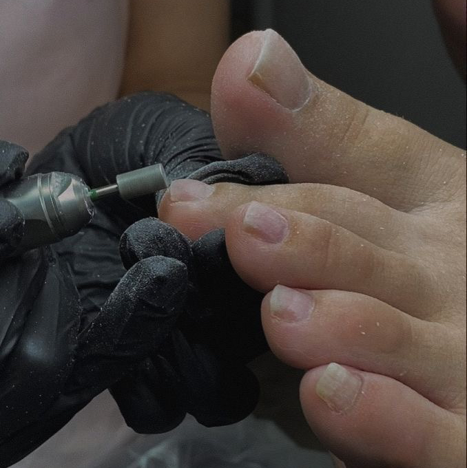 Подологический педикюр при изменениях  ногтей