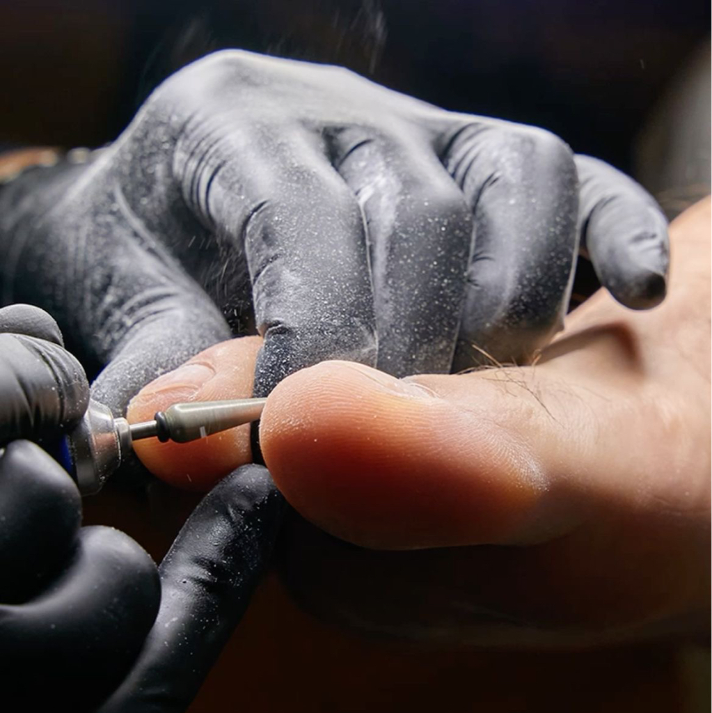 Обработка ногтя при врастании без удаления сегмента ногтя 1 ед