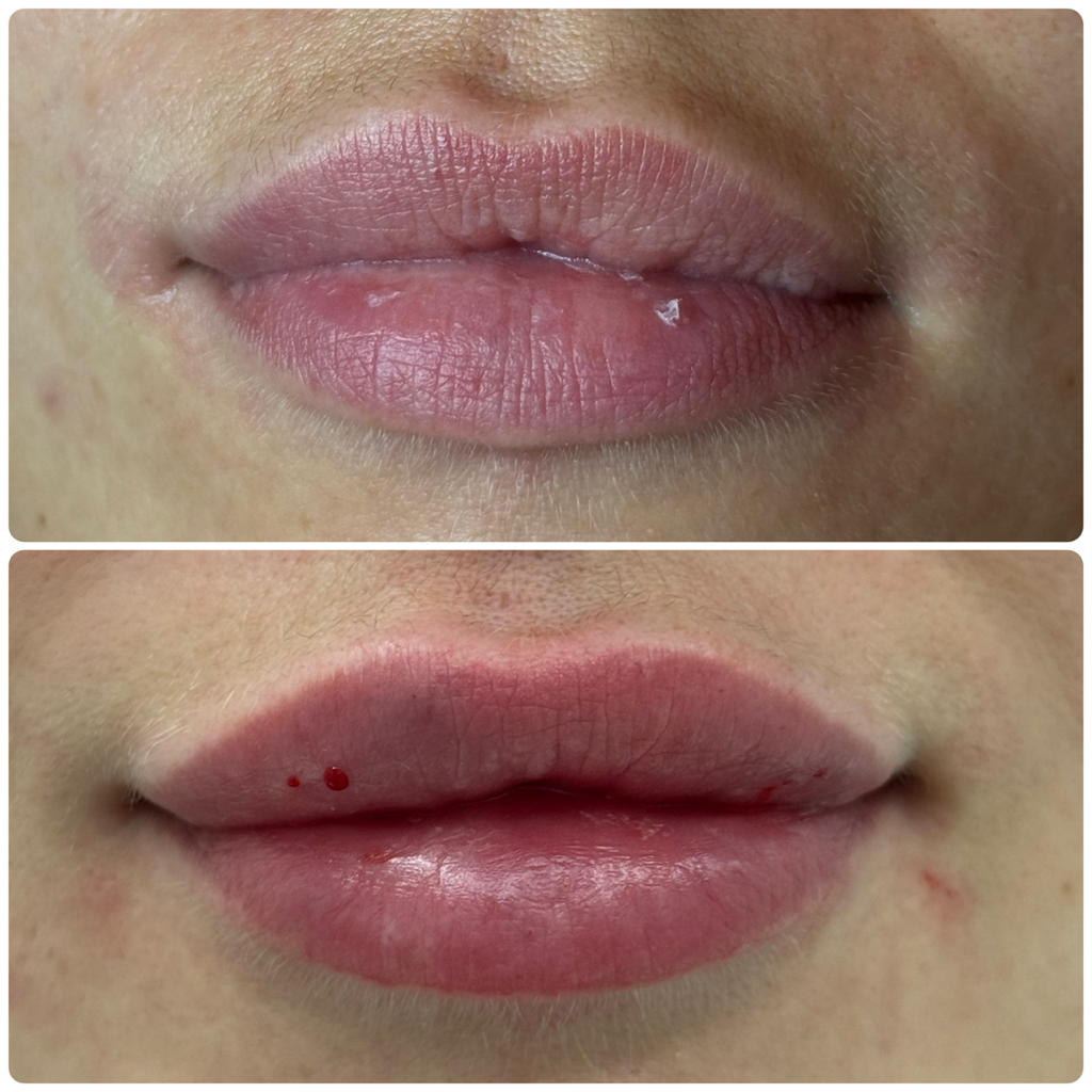 Увеличение губ 1 мл