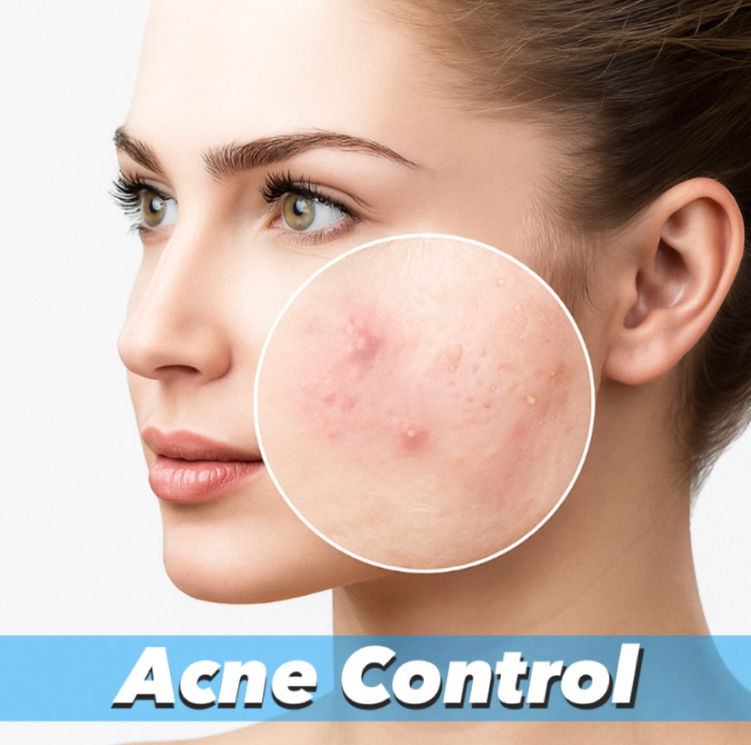 Acne Control
