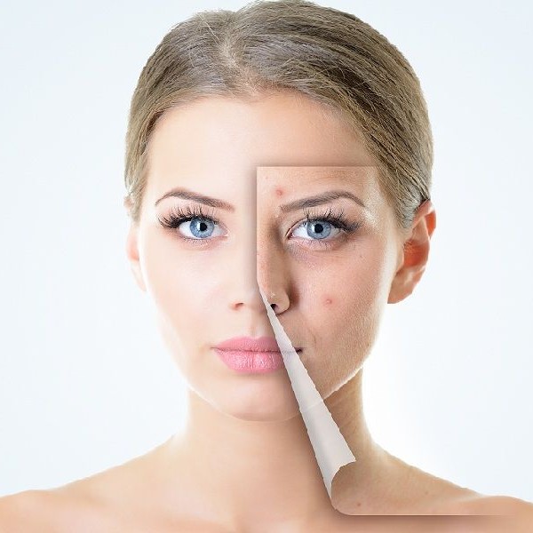 Лечение Акне Sin1,2