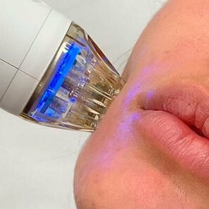 Микроигольчатый Rf -лифтинг лицо или шея