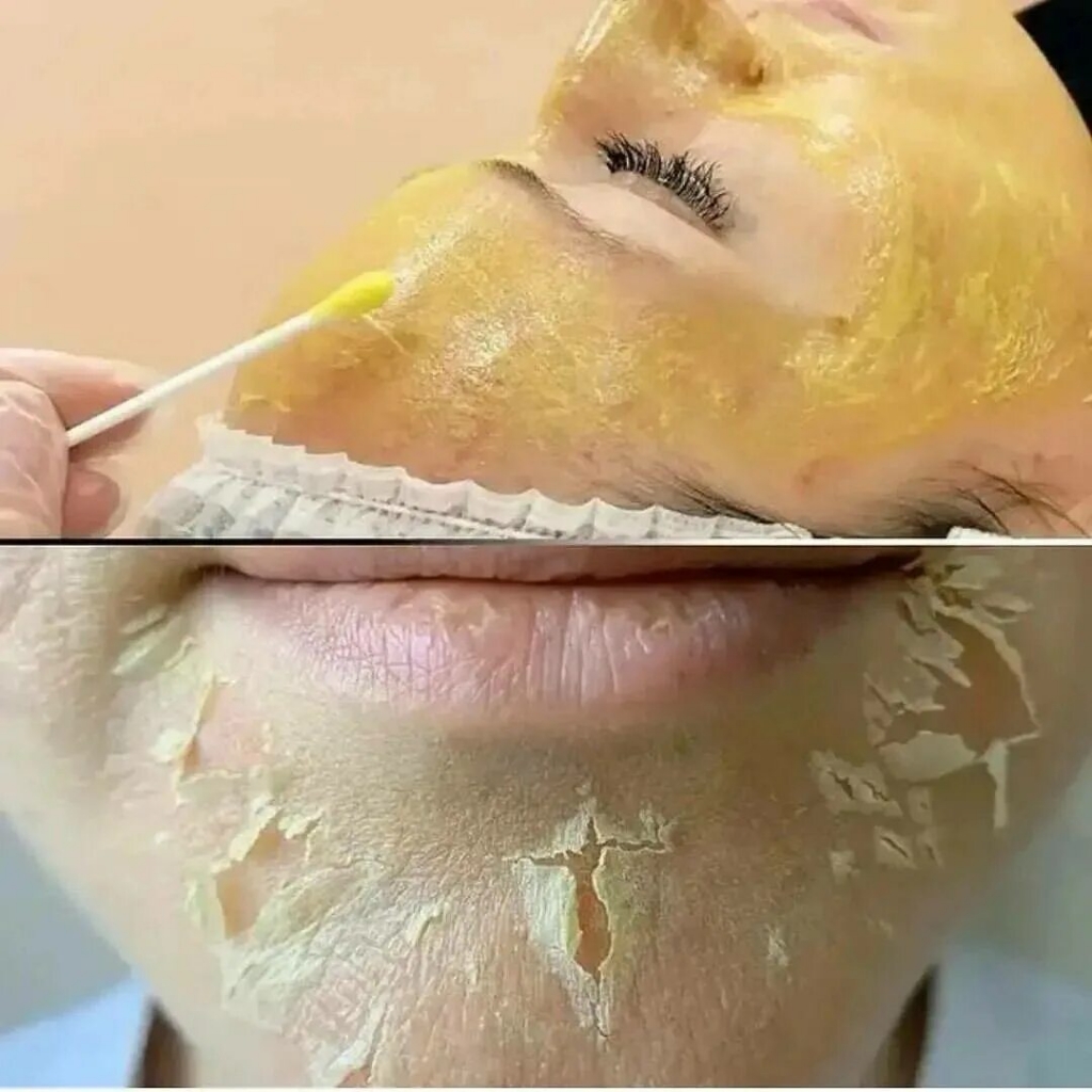 Желтый ретиноловый пилинг