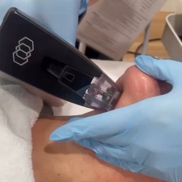 Микроигольчатый RF лифтинг (лицо+шея)