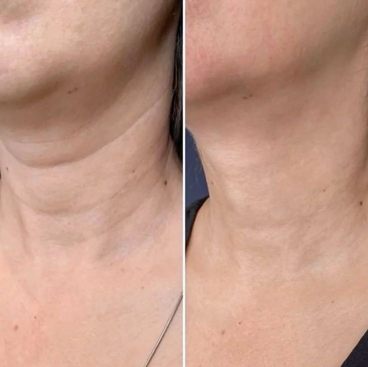 Микроигольчатый RF лифтинг (лицо, шея, зона декольте)