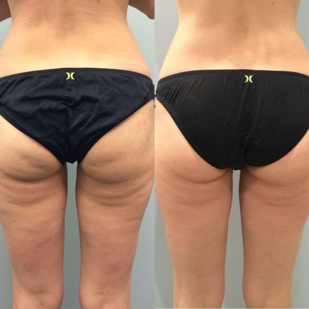 Микроигольчатый RF лифтинг (внутренняя поверхность бёдер+зона над коленями)