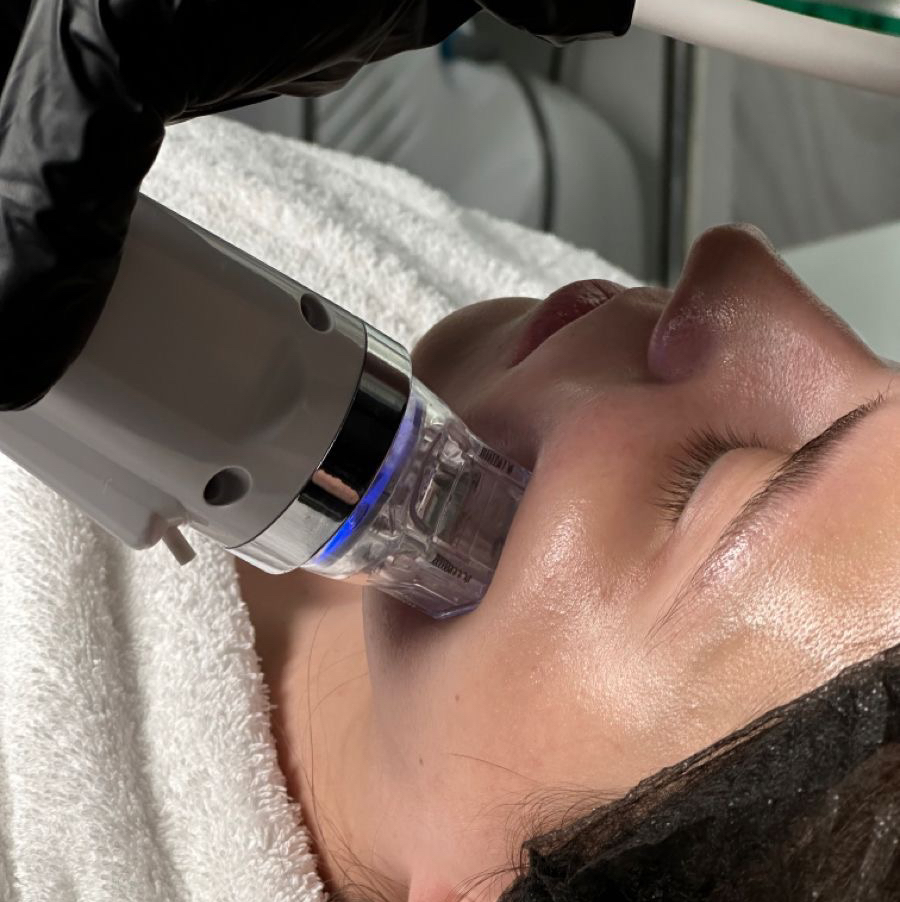 Микроигольчатый RF лифтинг (лицо)