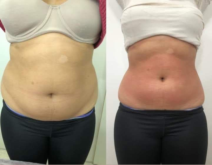 Микроигольчатый RF лифтинг (живот)