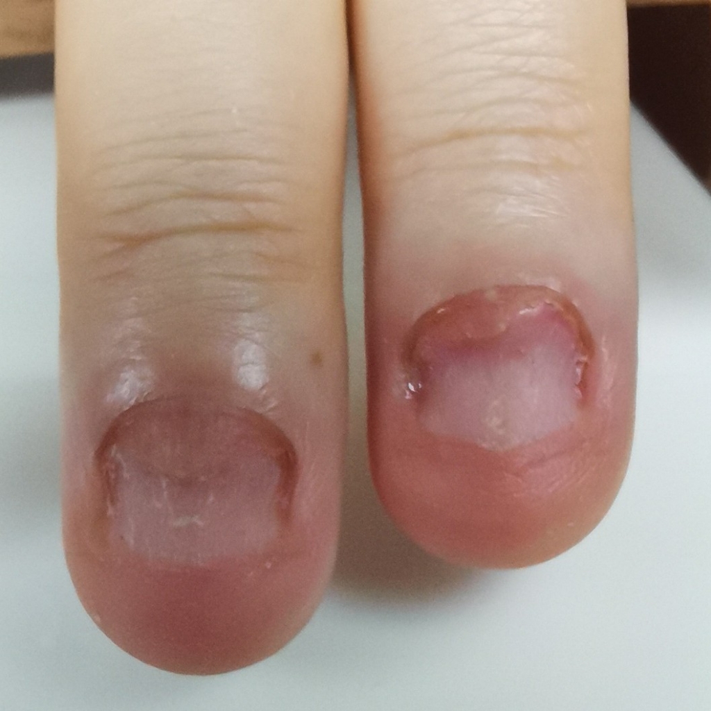 Сложный случай