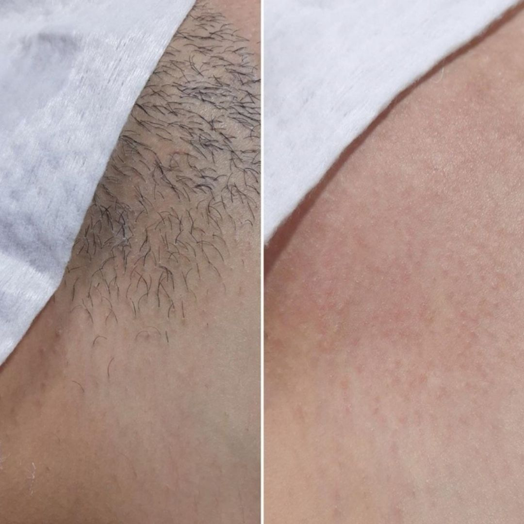 Глубокое бикини - сахар