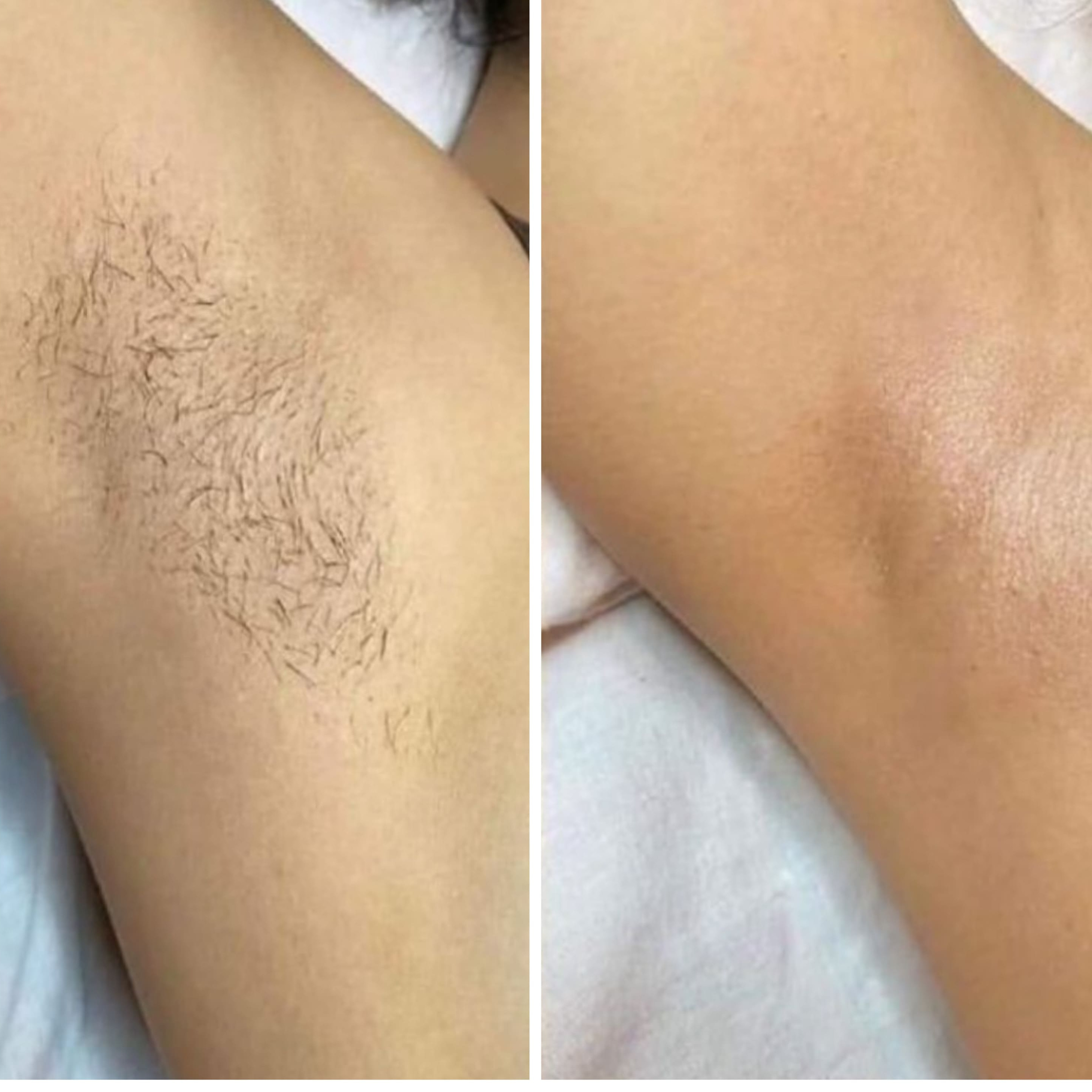 Подмышечные впадины - сахар