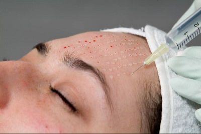 Постакне инъекционная мезотерапия пигментных пятен