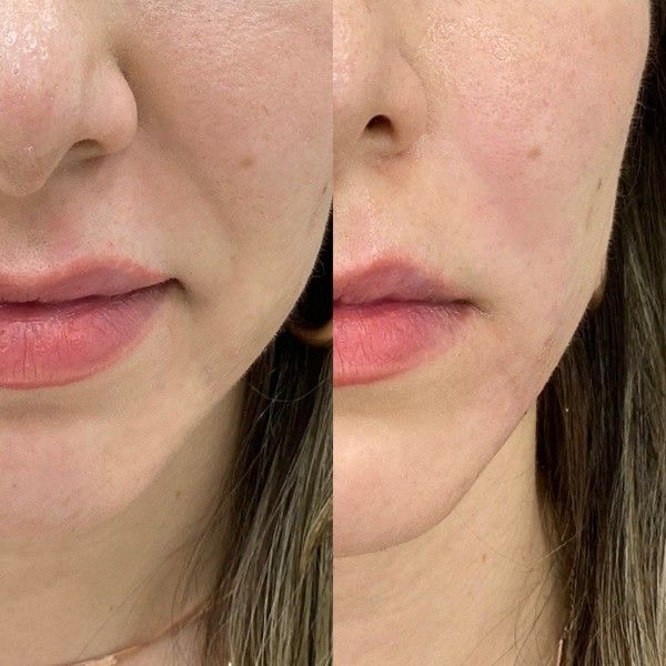 Контурная пластика носогубных складок