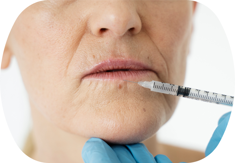 Контурная пластика кисетных морщин и морщин марионеток