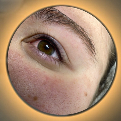 Межресничка