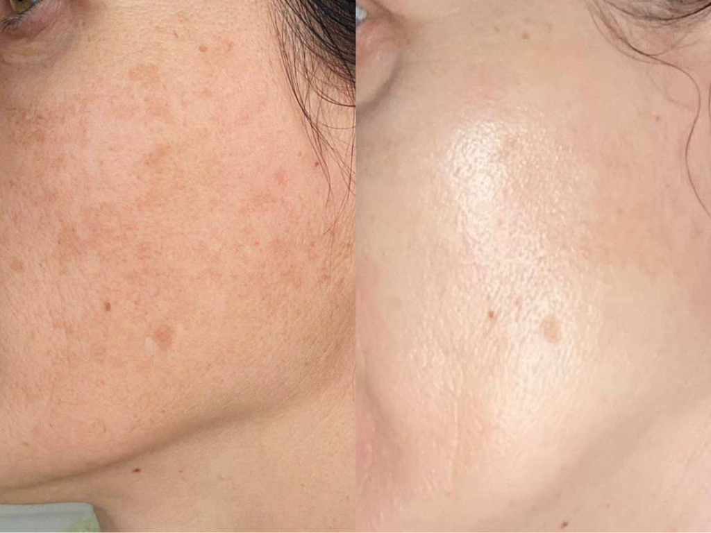 МИЛЛИОН PREMIUM - программа глубокого обновления кожи от NATINUEL (Италия) - массаж на озоновом масле, пилинг-полисофт, экзосомы, карбокси, спа-уход