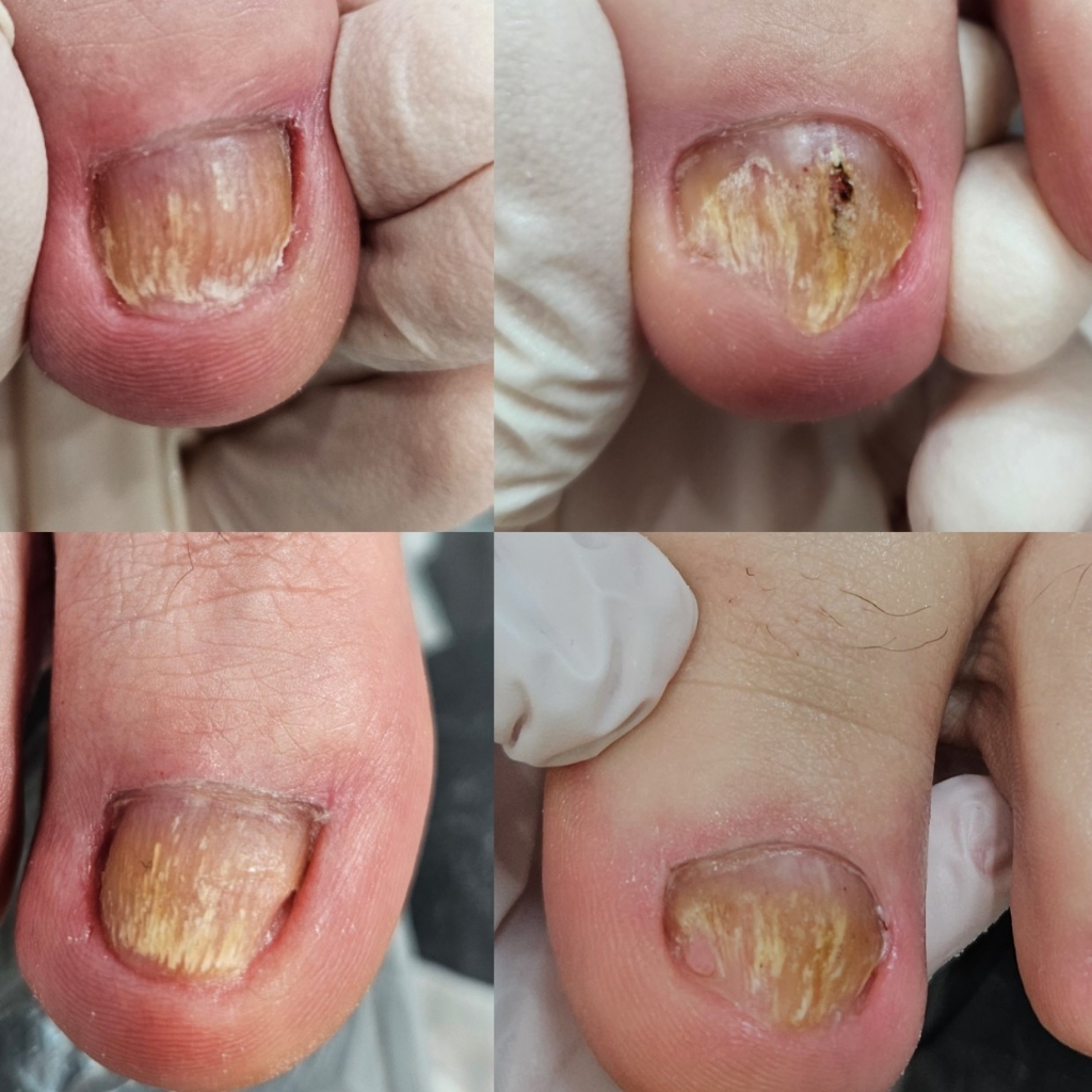 Зачистка микозных ногтей и онихолизиса на всех ногтевых пластинах/ с обработкой стопы