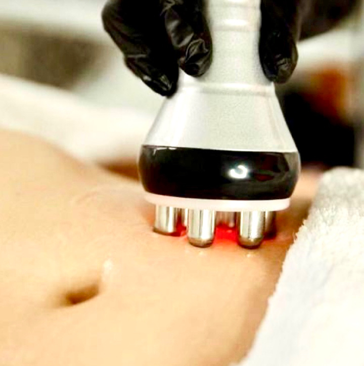 RF лифтинг тела