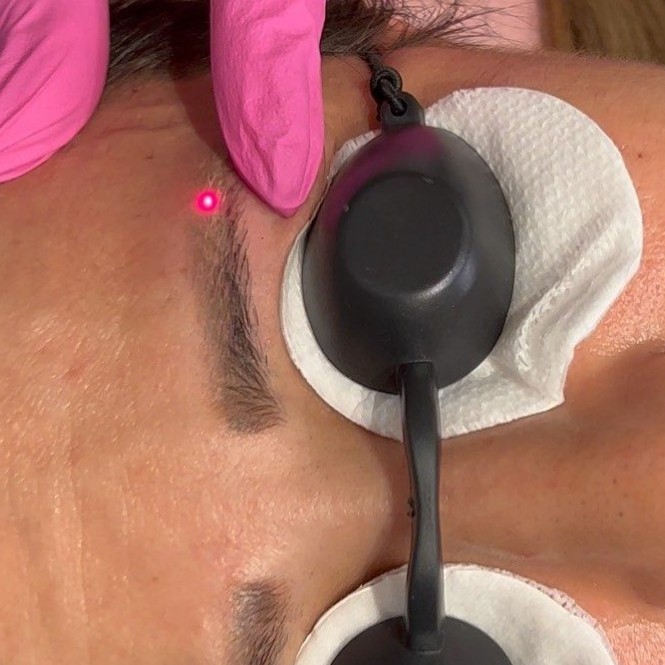 Удаление татуаж бровей