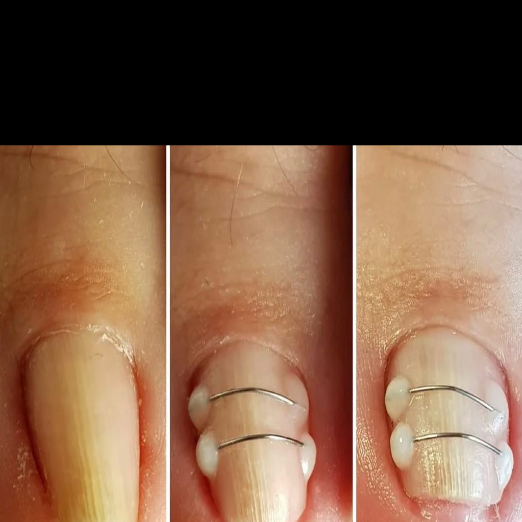 Установка коррекционной системы