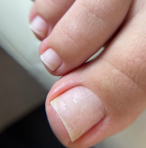 Снятие (педикюр)