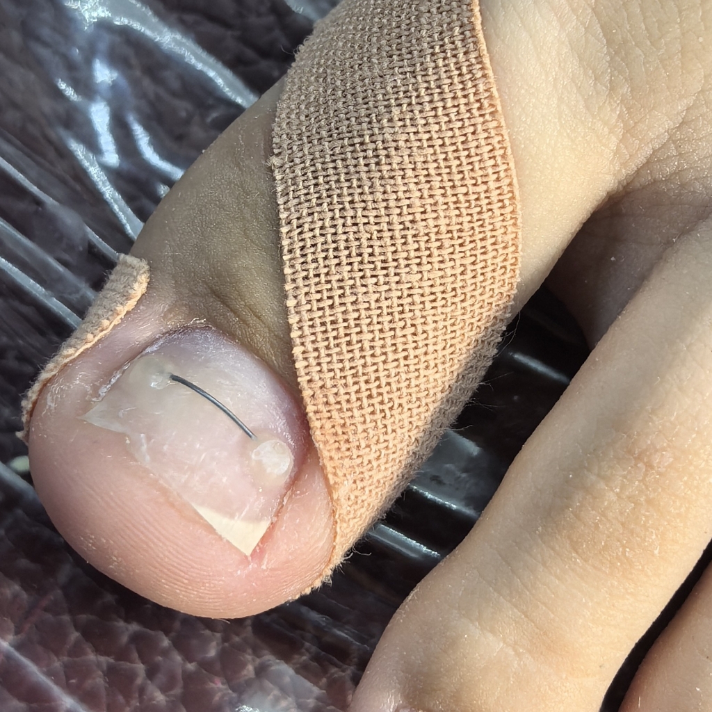 установка титановой нити