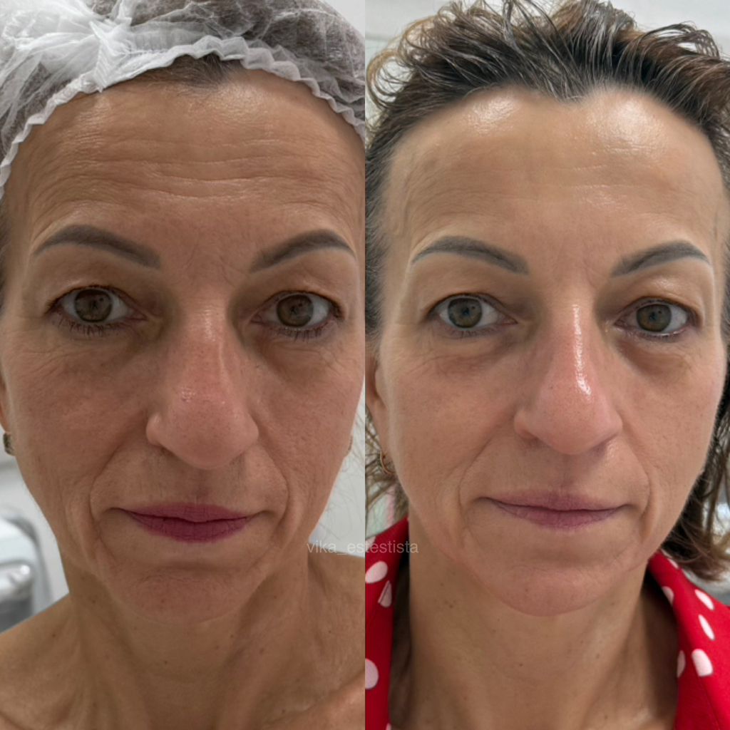 Скульптурно-буккальный массаж