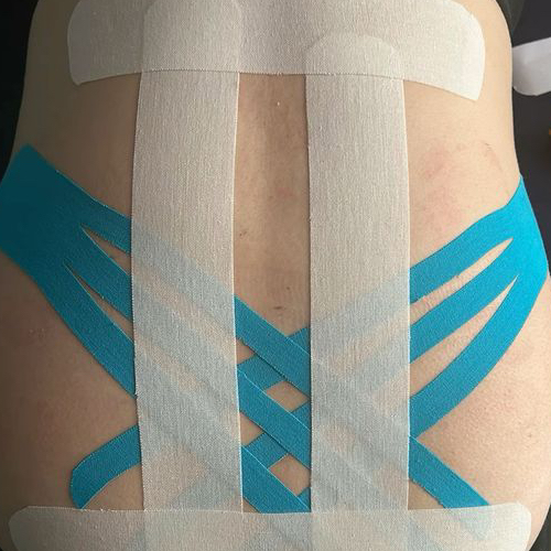 Тейпирование