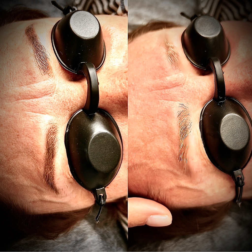 Лазерное удаление татуажа , перманентного макияжа