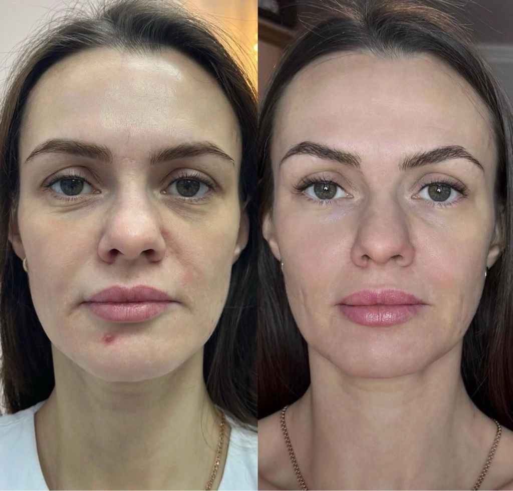 Скульптурирование лица методом Холодная плазма