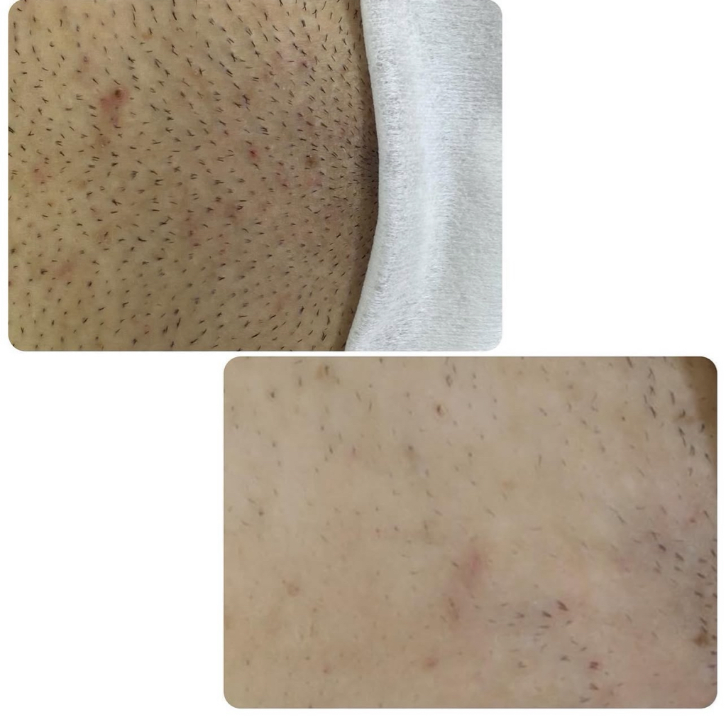 Бикини полностью, подмышки