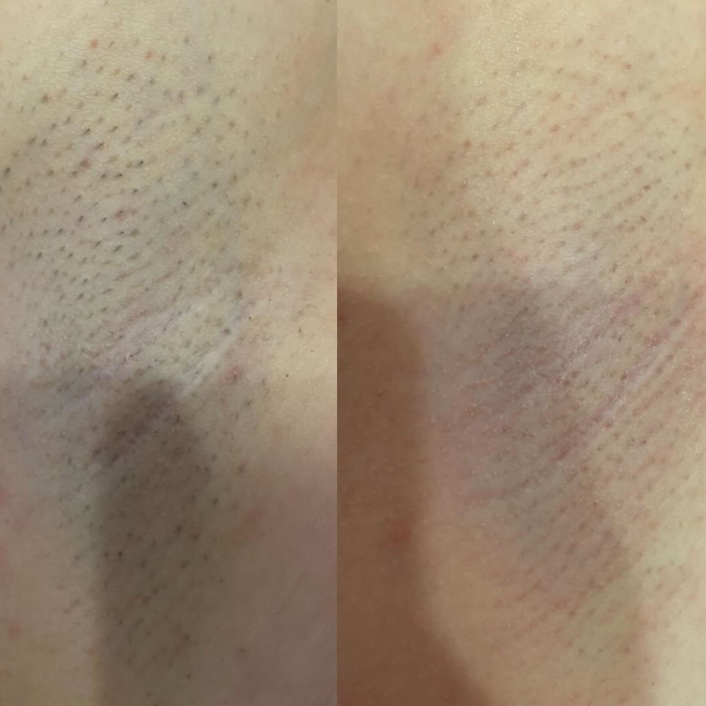 Бикини полностью, ноги полностью, подмышки