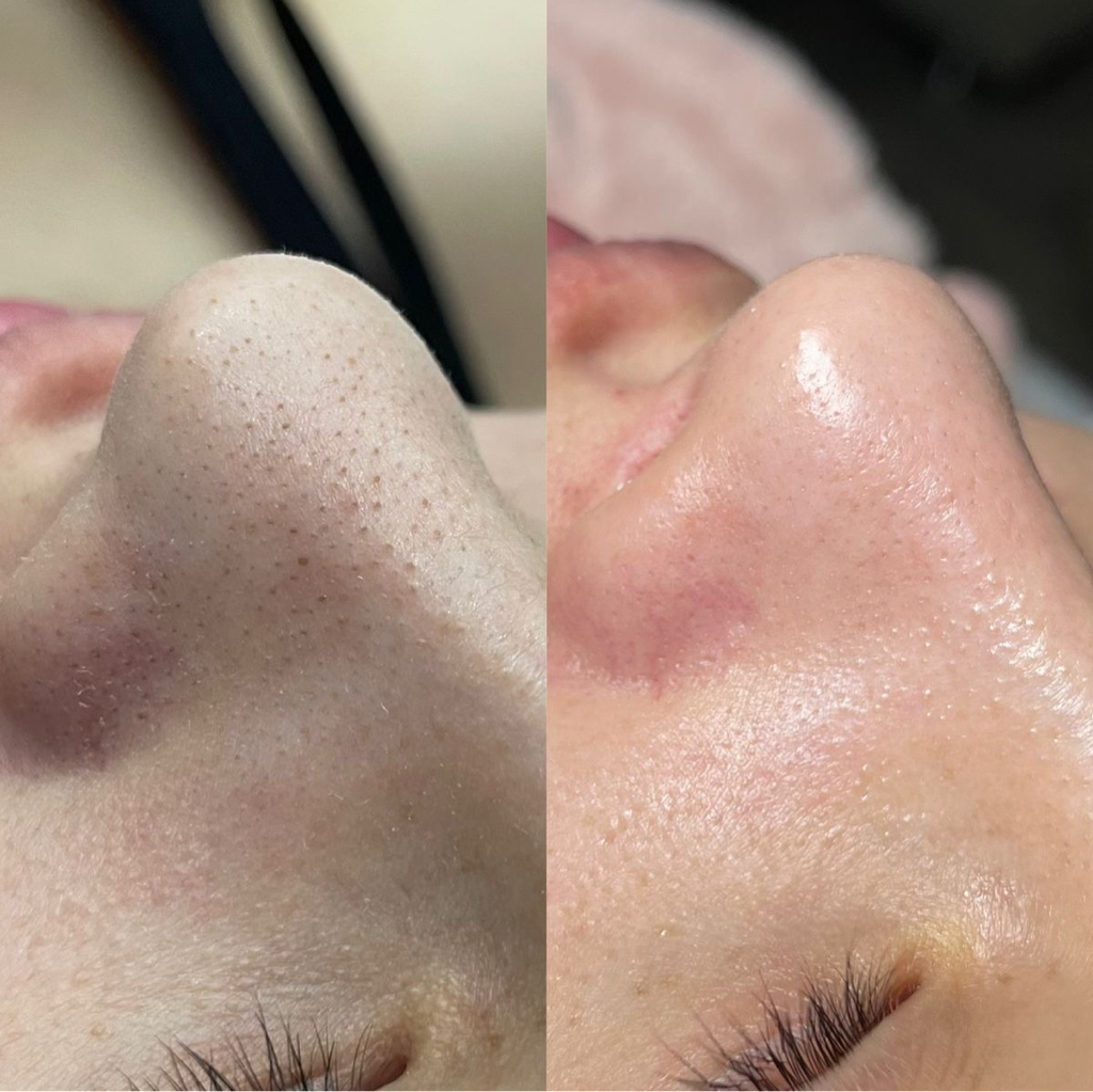 АКЦИЯ: Механическая чистка + поверхностный пилинг