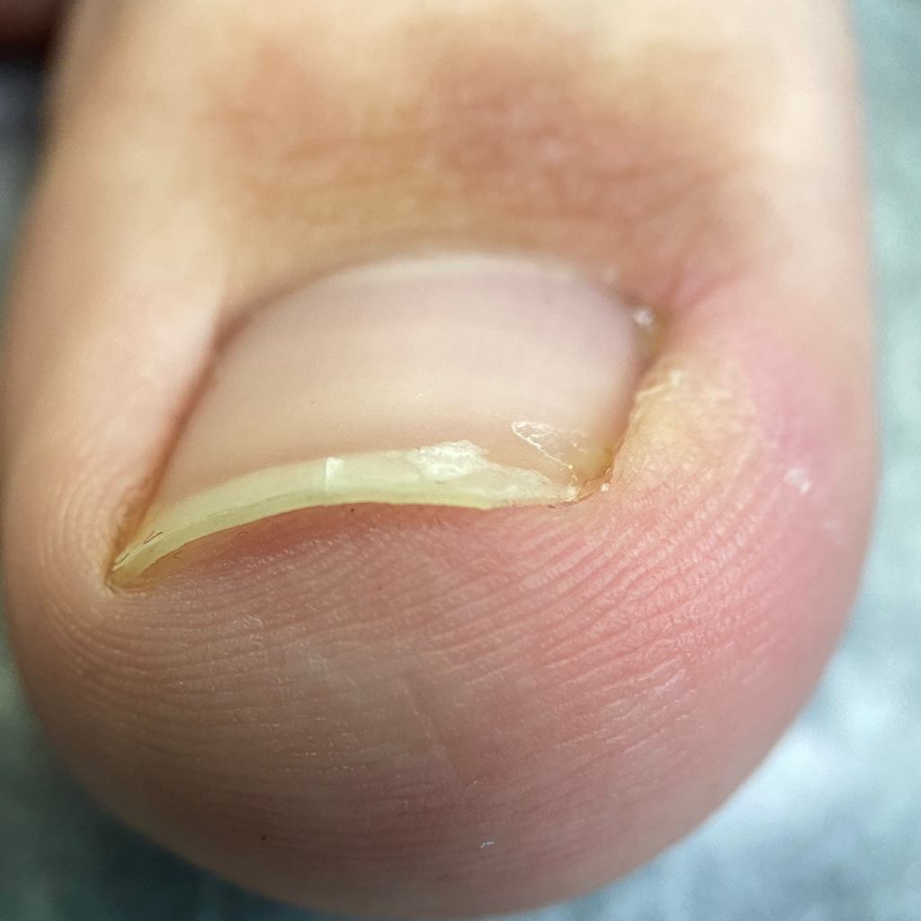 Деформированные ногти (онихокриптоз) 1 СТЕПЕНИ 1 единица  (отек бокового валика, покраснение)