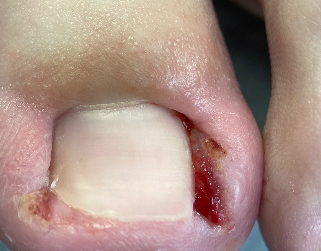 Деформированные ногти (онихокриптоз) 3 СТЕПЕНИ 1 единица  (отек бокового валика, покраснение, гноетечение, грануляция) + при необходимости временная к