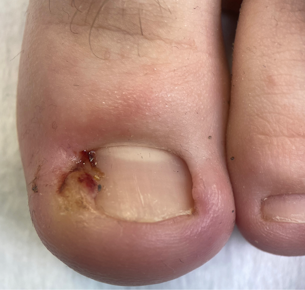 Деформированные ногти (онихокриптоз) 2 СТЕПЕНИ 1 единица  (отек бокового валика, покраснение, гноетечение)