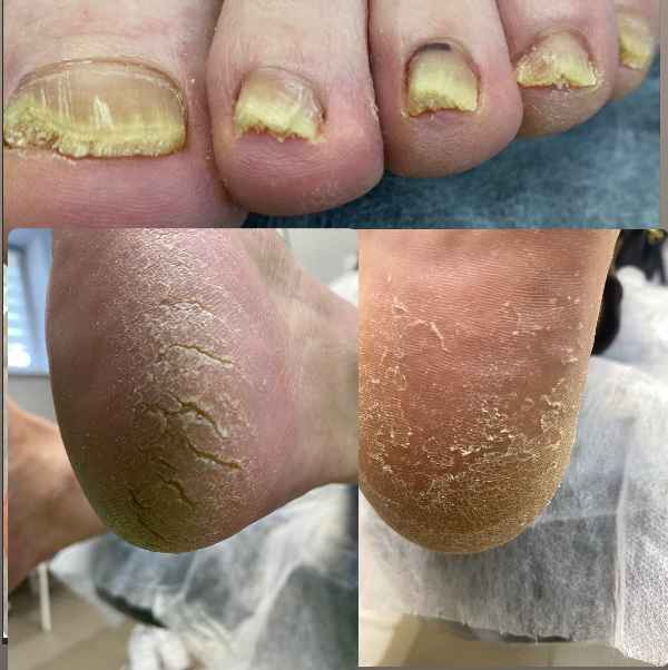 Комплексная обработка стоп и ногтей 3 СТЕПЕНИ (Обработка стопы с гиперкератоз, обработка мозоли, обработка трещин, обработка пораженных НП 10шт)