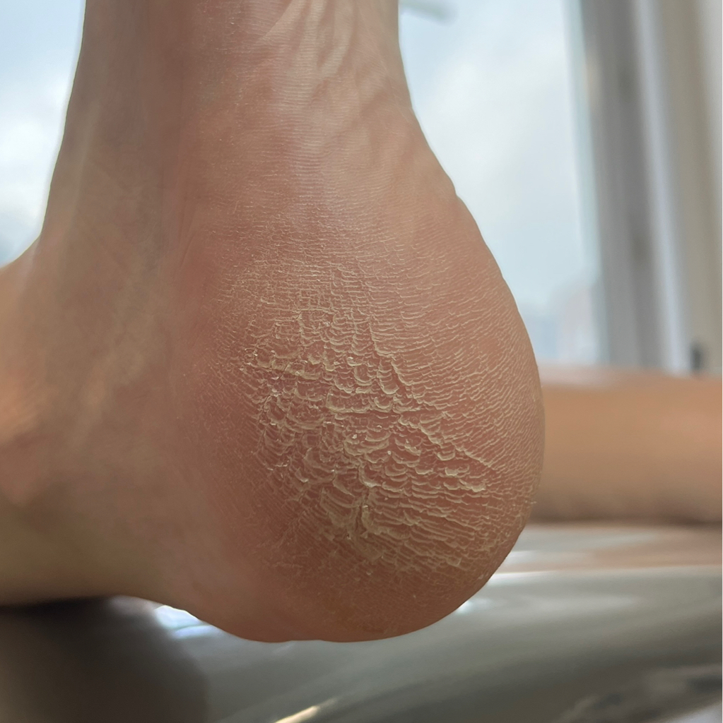 Обработка проблемной стопы  (Без обработки пальчиков и покрытия)