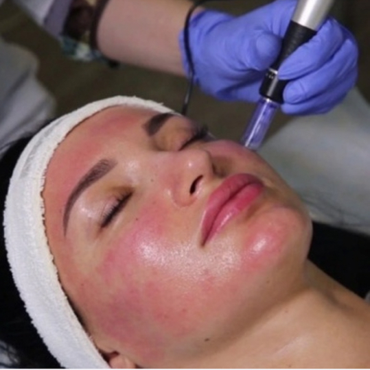 Дермапен Фракционная мезотерапия