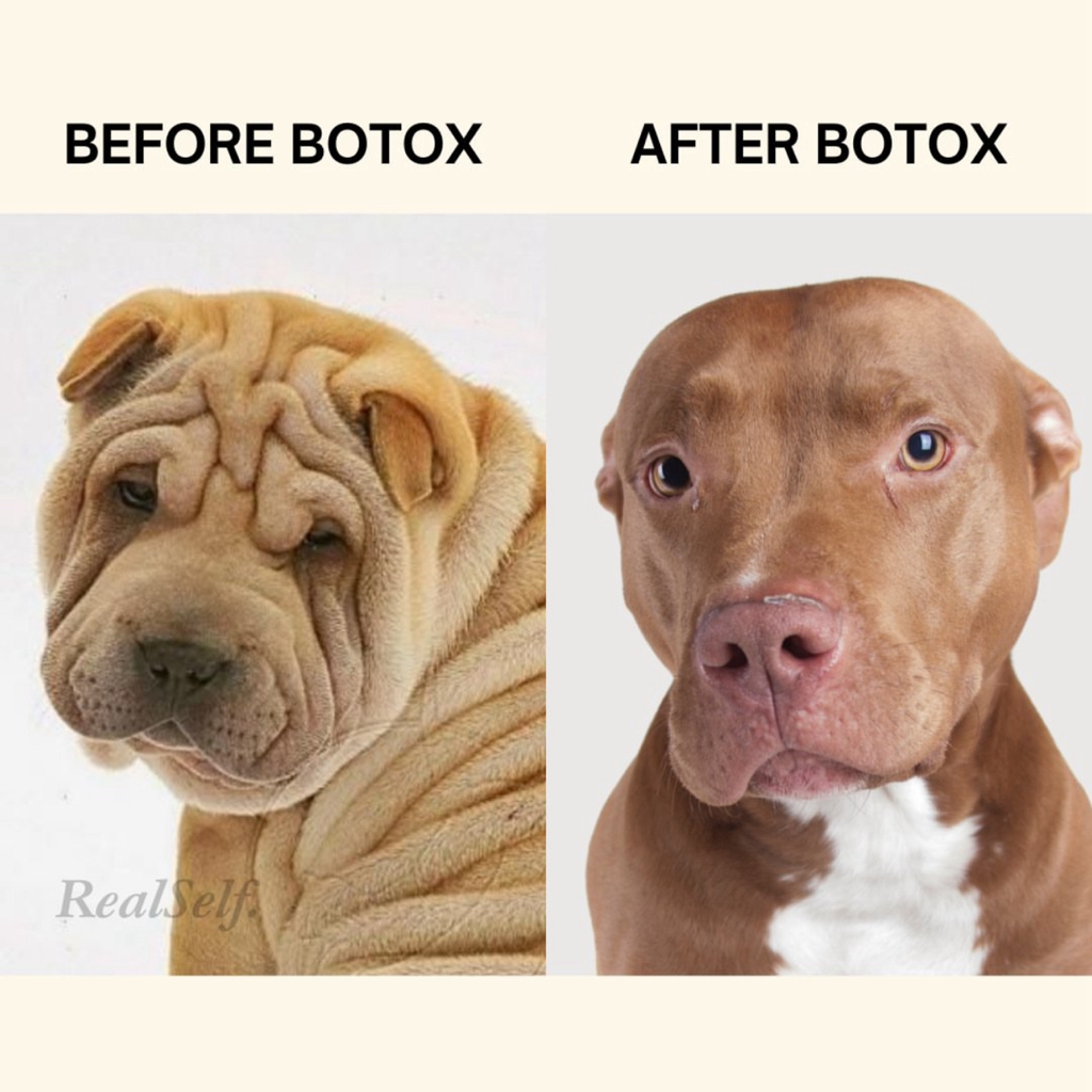 Ботулинотерапия